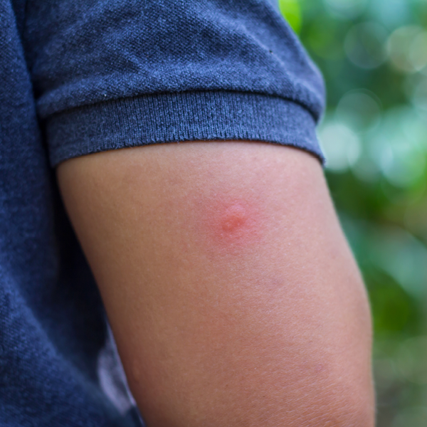 Arm in T-Shirt mit Mückenstich