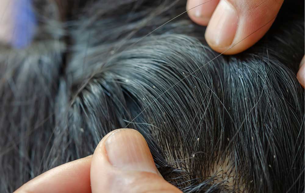 Wie erkenne ich Kopfläuse? Zwei Hände schauen auf einem Kopf nach Läuse und schieben die Haare beiseite