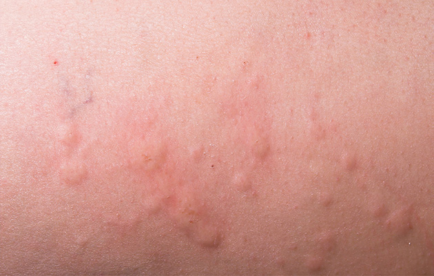 Stechmücke als Krankheitsüberträger Es ist eine mit Pickeln übersähte Hautstelle zu sehen